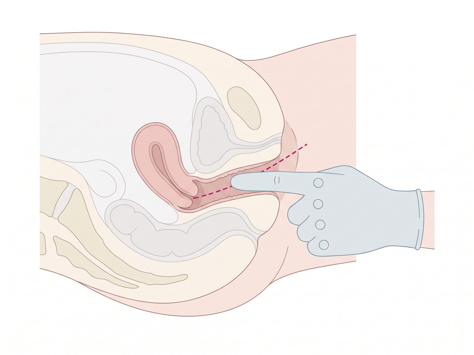 검지를 넣어 끝이 자궁경부에 닿는 깊이를 마디로 가늠하는 모습을 보여주는 골반 단면도